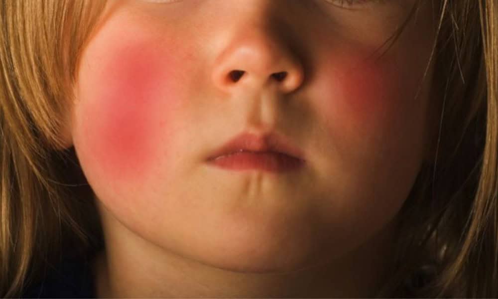 MEDICINA / Dermatite atopica, cause e rimedi - QdM Notizie